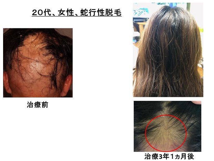 円形脱毛症　病院